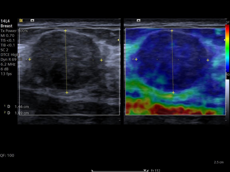 acuson-juniper-eSie-Touch-strain-elastography